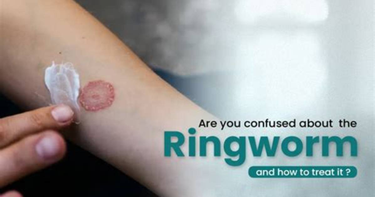 Will Diflucan Treat Ringworm?