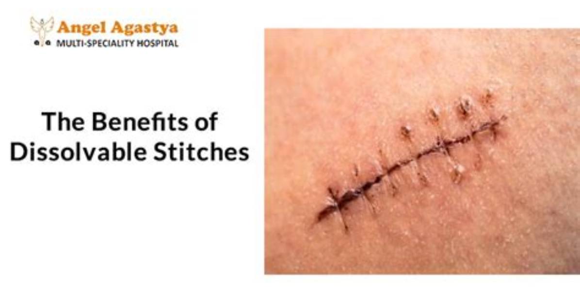 Will Dissolvable Stitches Always Dissolve?
