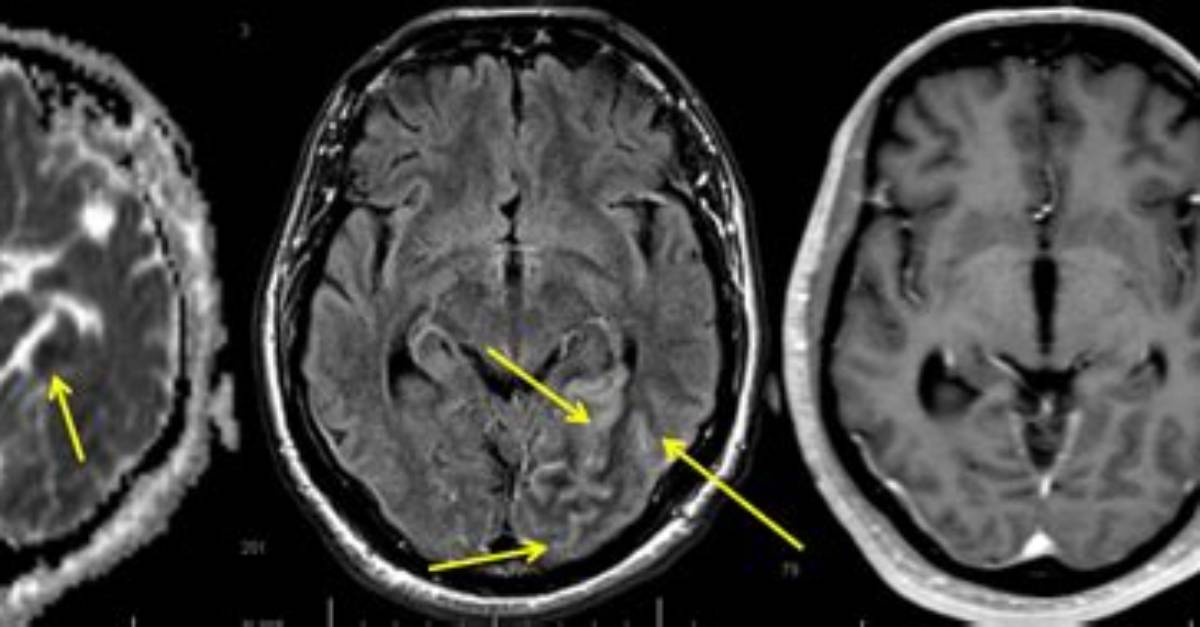 Will Encephalitis Show on Mri?