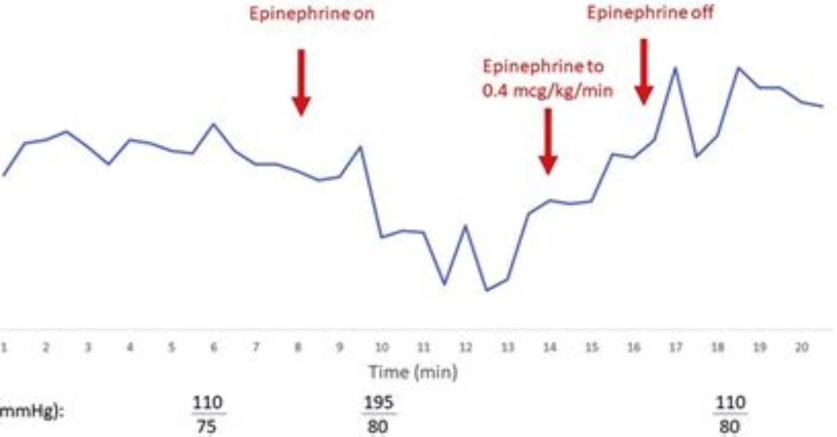 Will Epinephrine Affect Heart Rate?