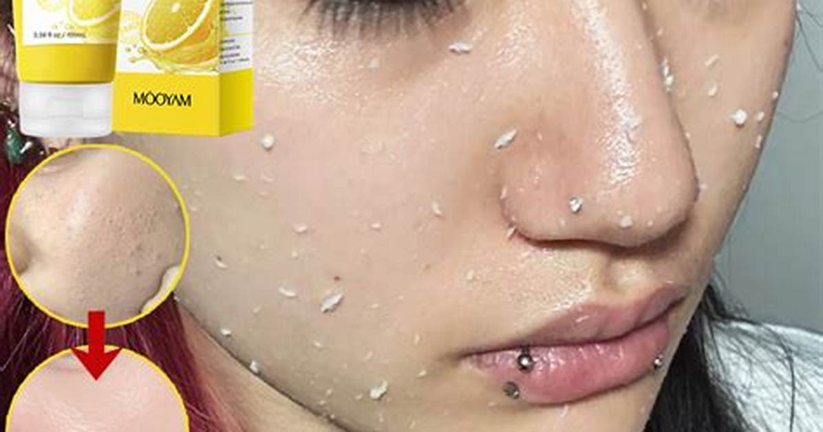Will Exfoliating Remove Blackheads?