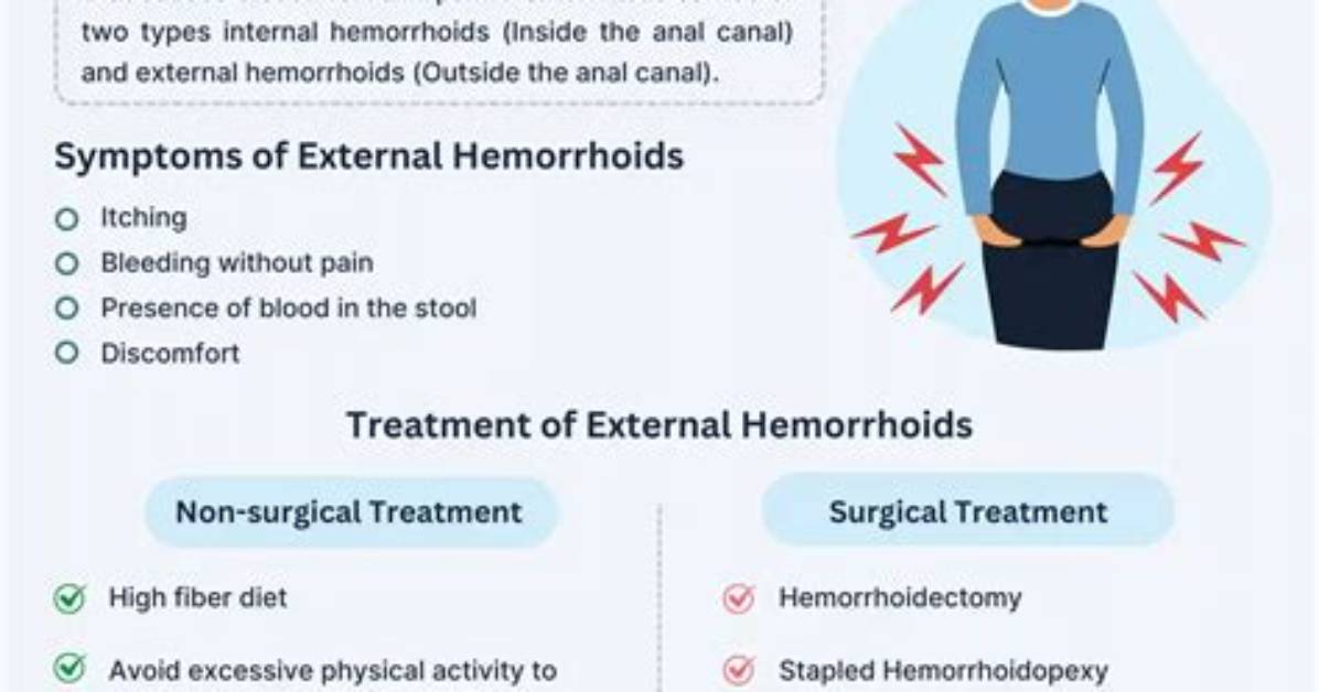 Will External Hemorrhoids Go Back in?