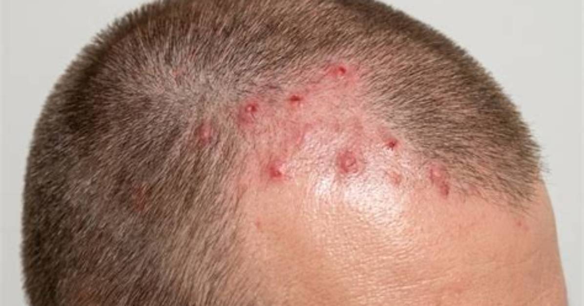 Will Flat Spot on Head Go Away?