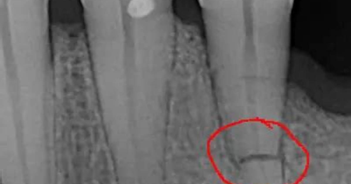 Will Fractured Tooth Root Heal?