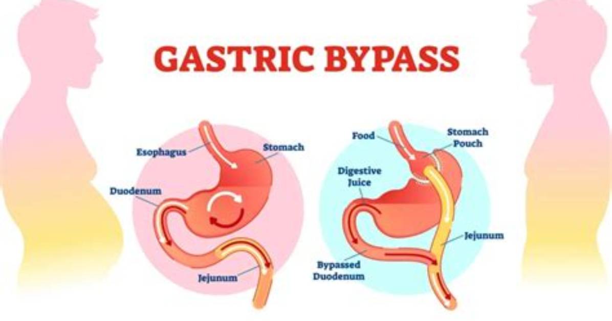 Will Gastric Bypass Help Diverticulitis?