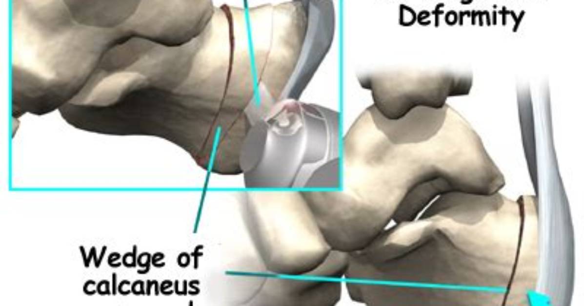 Will Haglund Deformity Go Away?