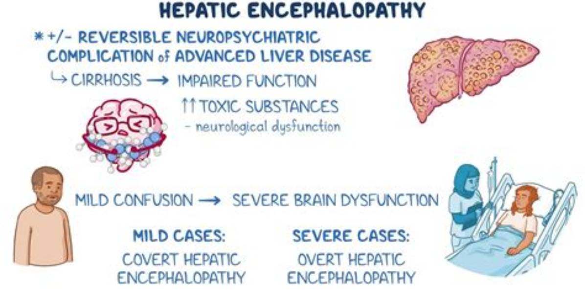 Will Hepatic Encephalopathy Kill You?