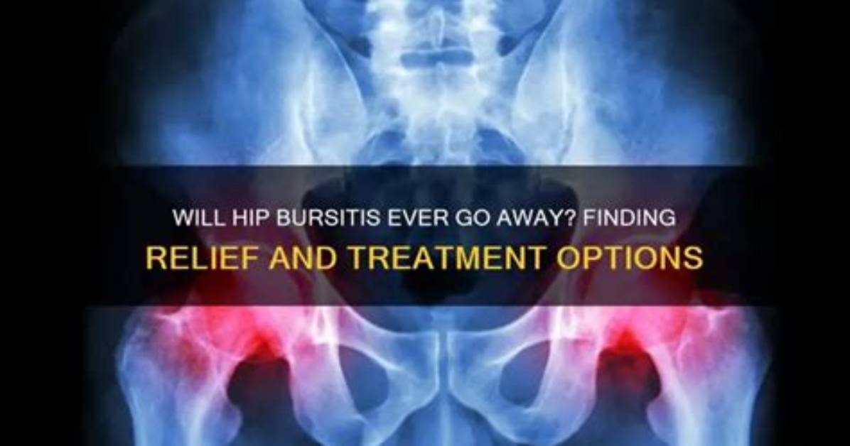 Will Hip Bursitis Go Away?