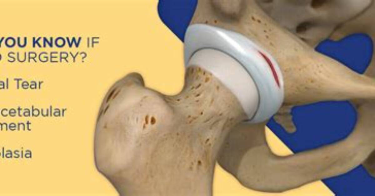Will Hip Labrum Repair Itself?