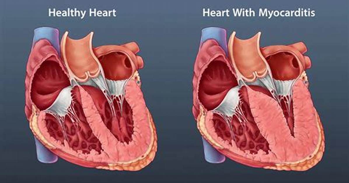Will I Die from Myocarditis?