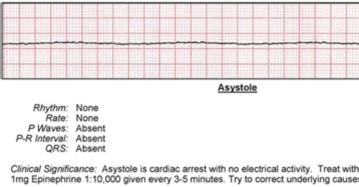 Will Icd Shock Asystole?