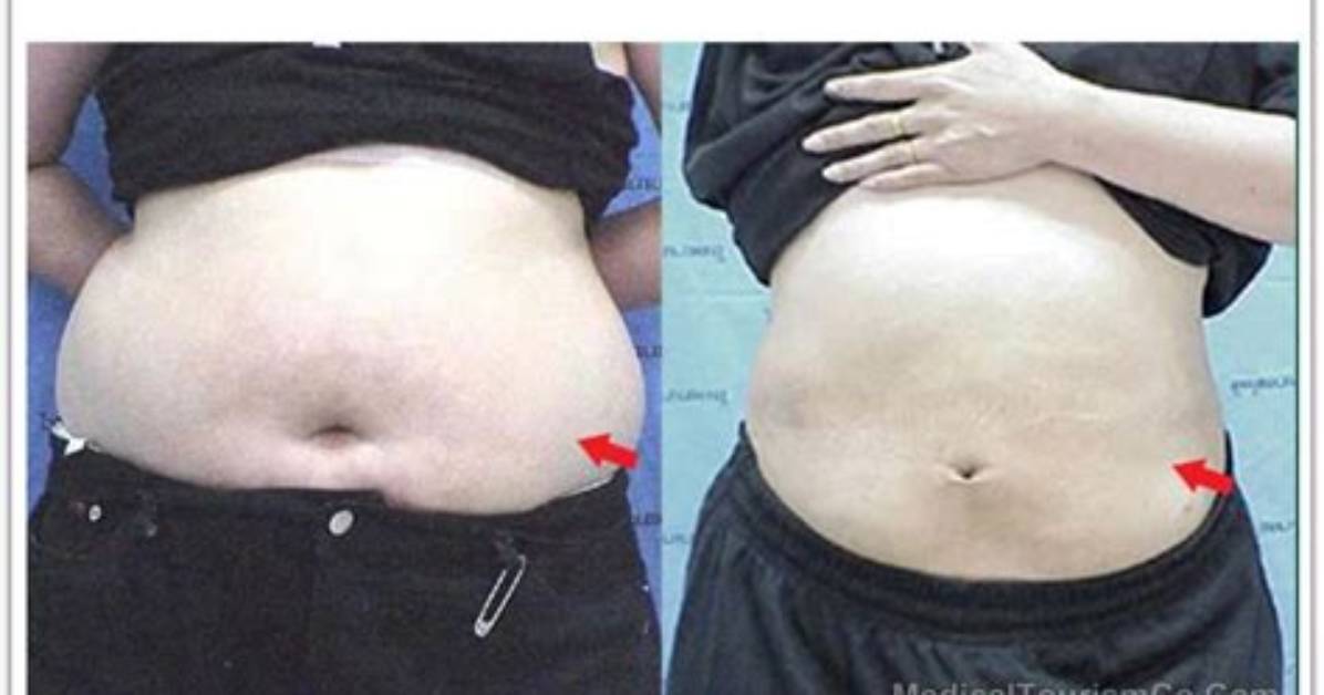 Will Liposuction Flatten My Stomach?