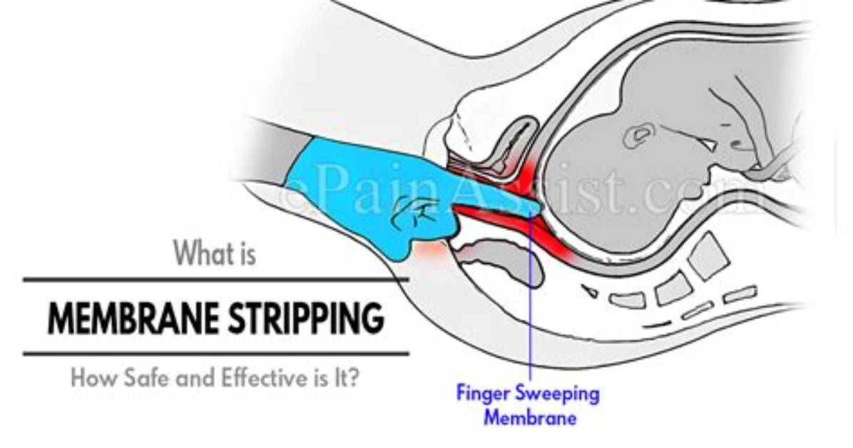 Will Membrane Stripping Induce Labor?