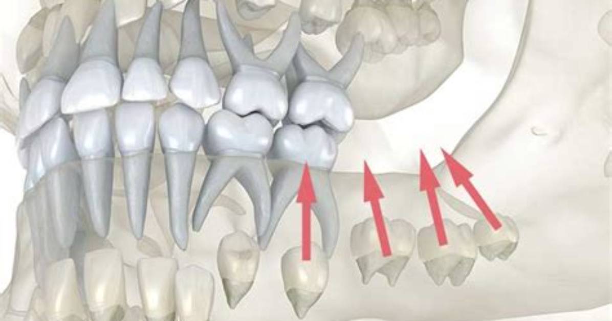 Will Molars Fall off?