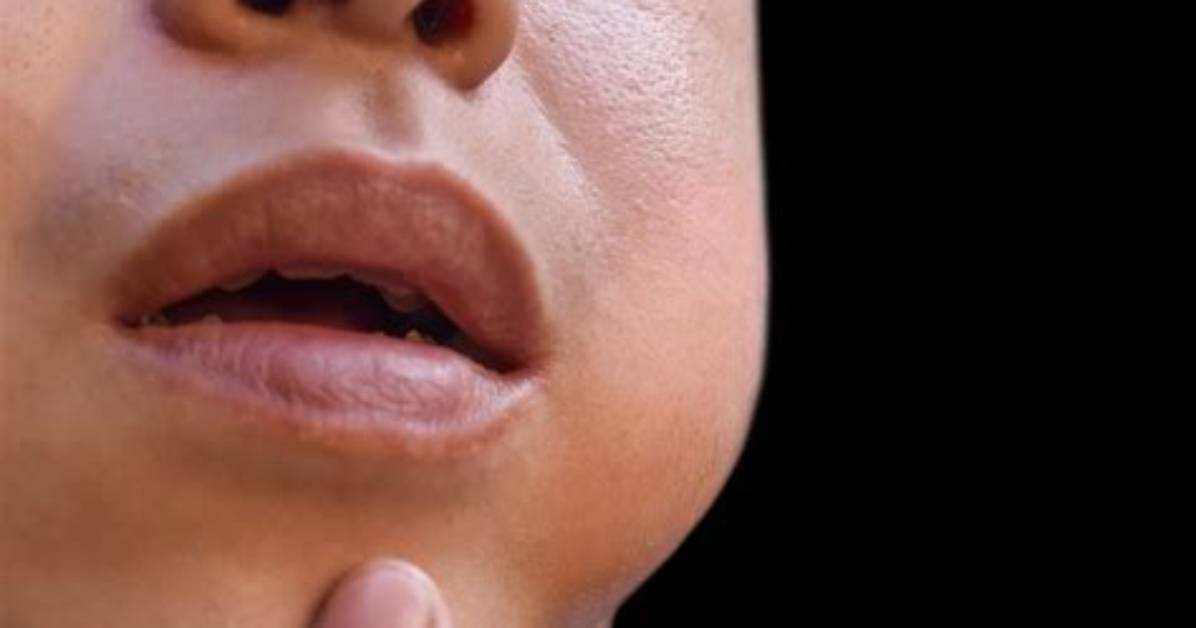 Will Mumps Go Away?