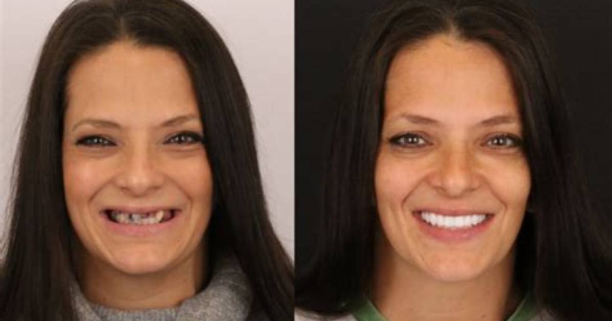 Will My Face Change with Dentures?