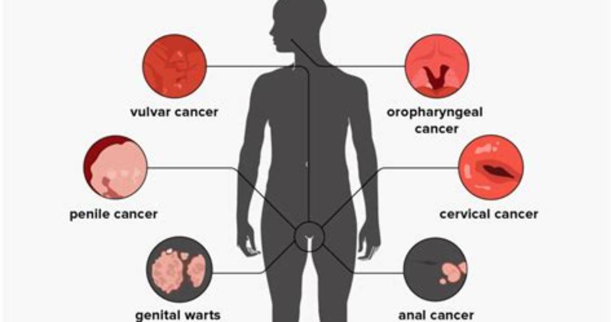 Will My Persistent Hpv Go Away?