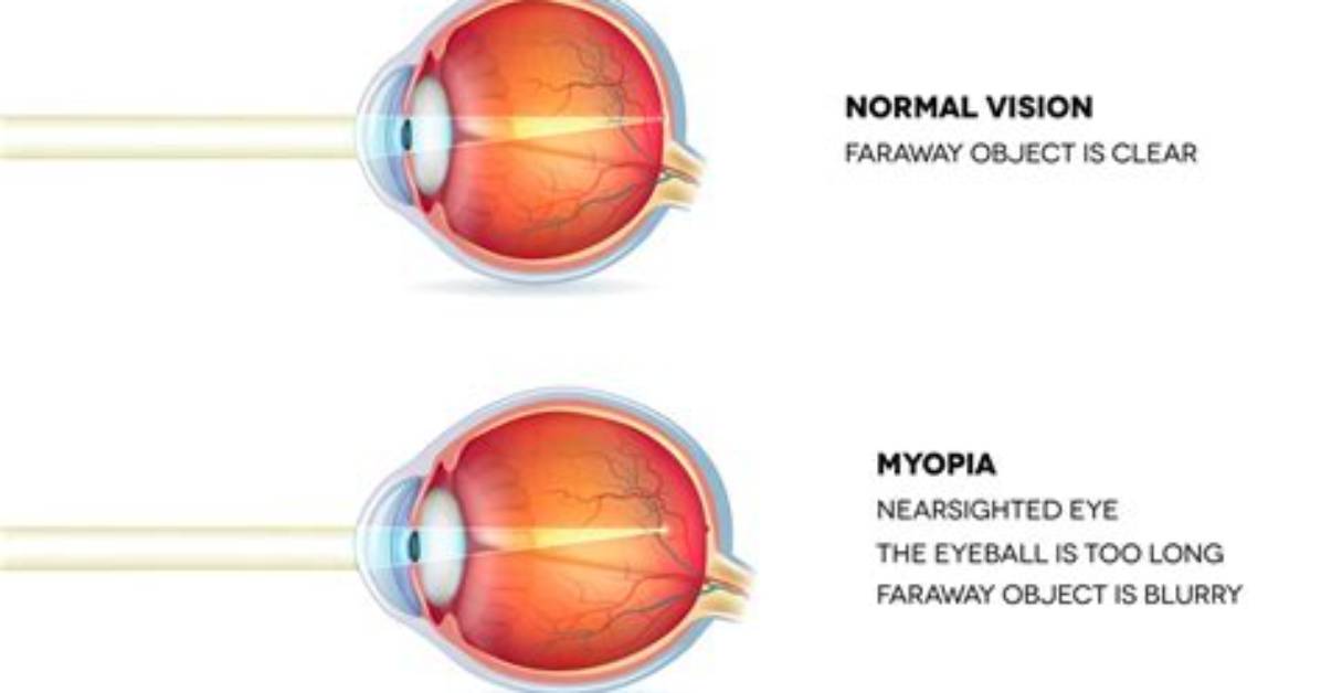 Will Myopia Get Worse?