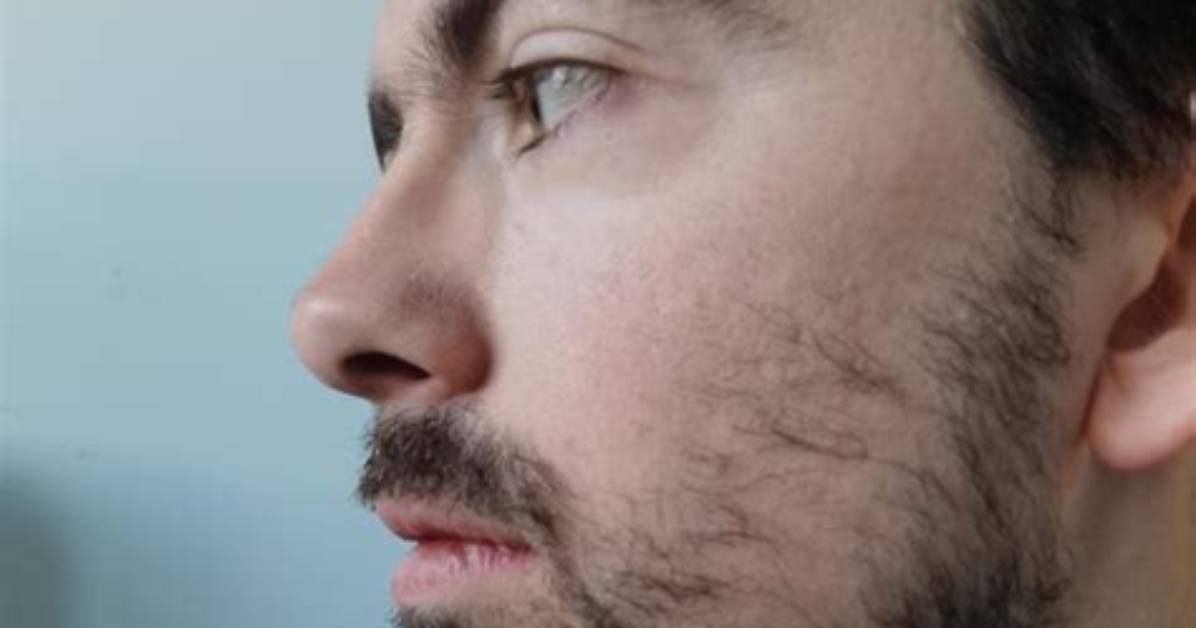Will Patchy Cheeks Fill in?