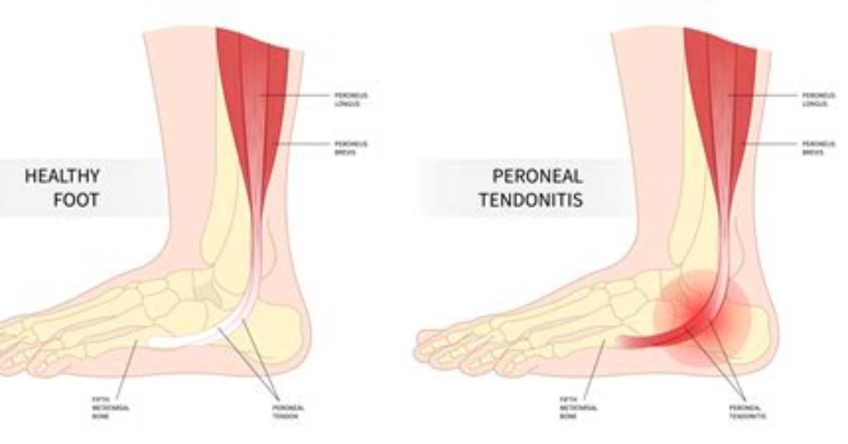 Will Peroneal Tendonitis Go Away?