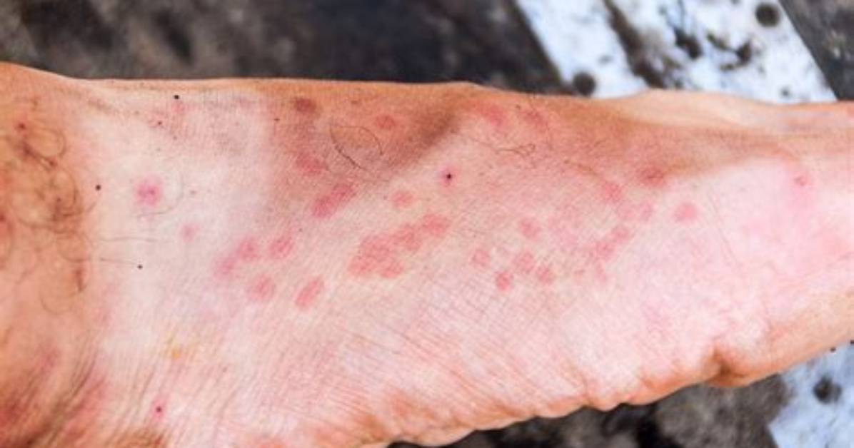 Will Sand Fly Bites Leave Scars?