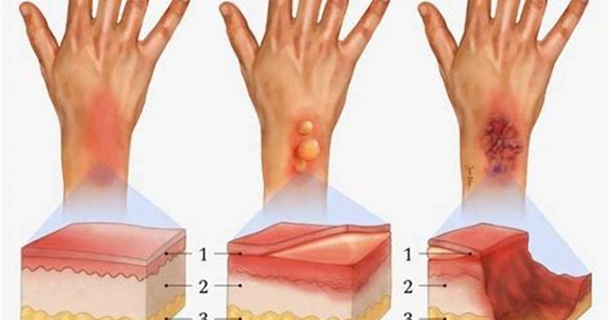 Will Second Degree Burns Scar?