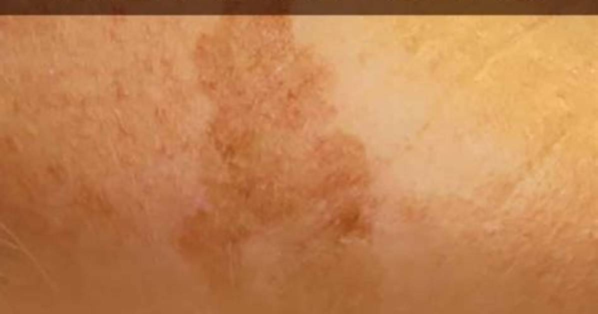 Will Sun Spots Go Away?