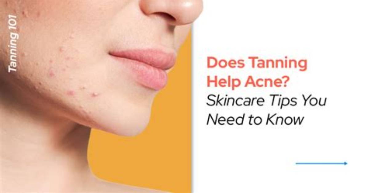 Will Tanning Help with Acne?