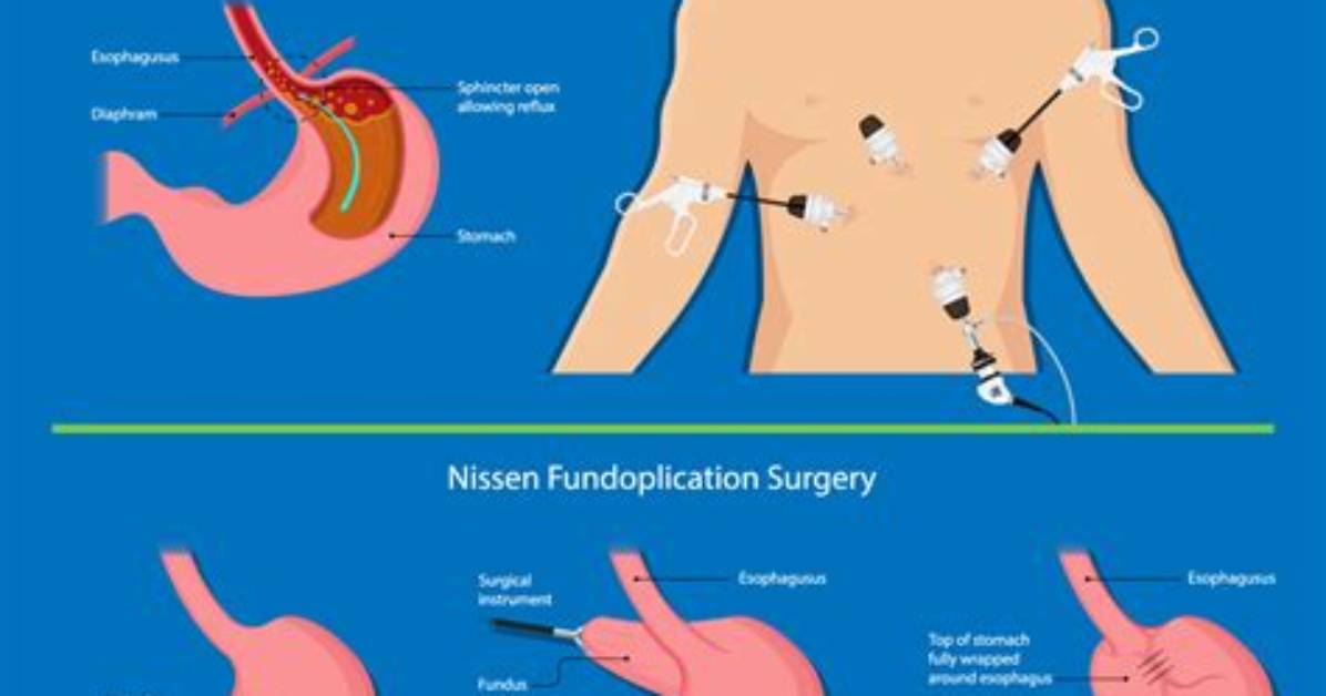 Will Vomiting Undo Nissen Fundoplication?