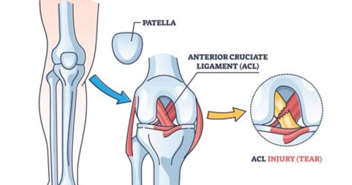 Will Walking on a Torn Acl Make It Worse?