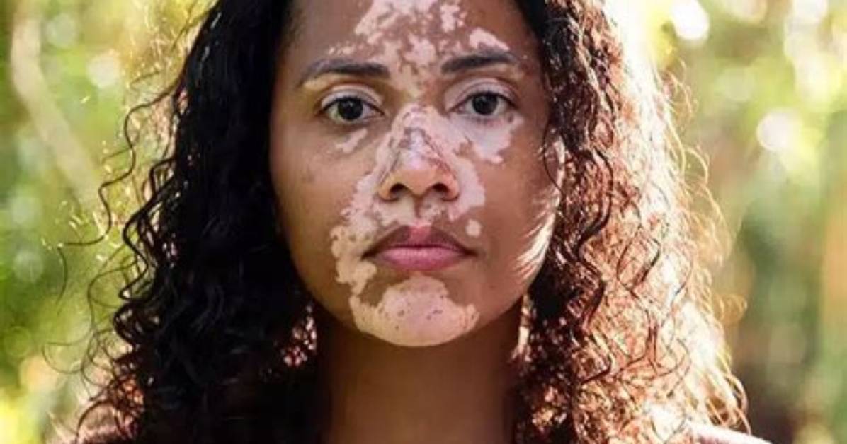 Woman with Rare Skin Condition Overcomes Negativity and Finds True Love