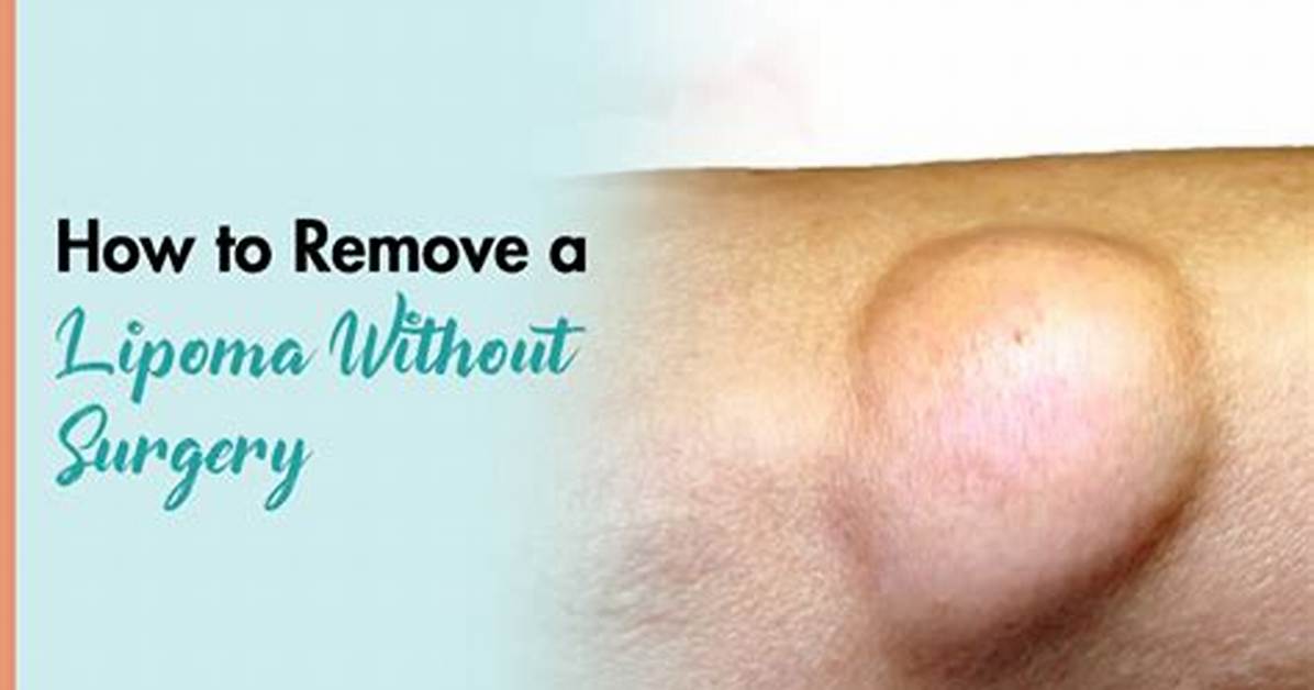 Would a Dermatologist Remove a Lipoma?