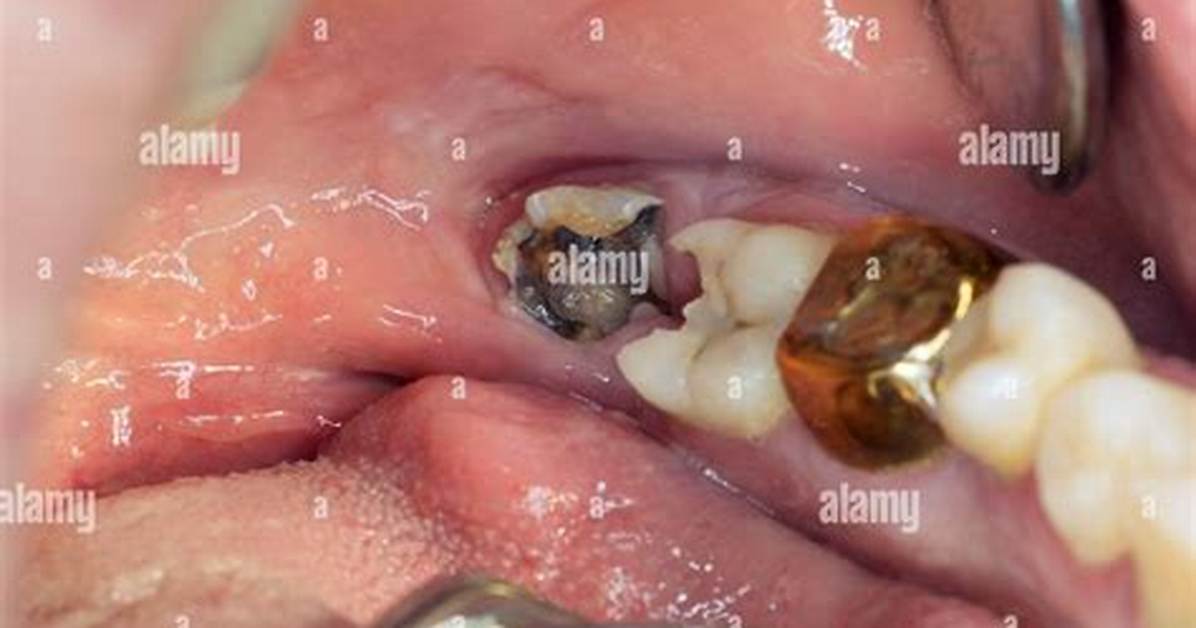 Would a Rotting Wisdom Tooth Cause?