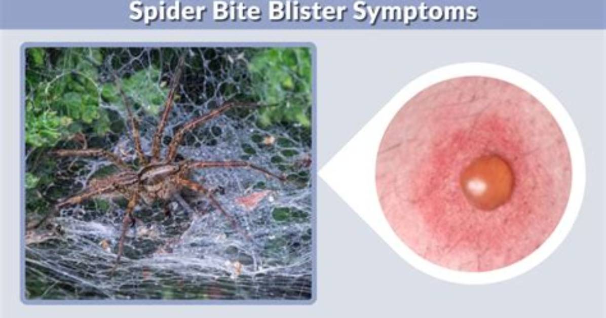 Would a Spider Bite Blister?