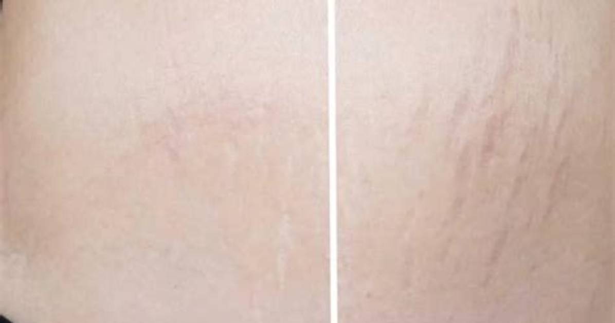 Would Stretch Marks Disappear?